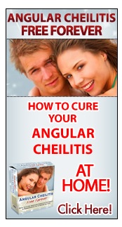 Click here to cure angular Cheilitis at home.